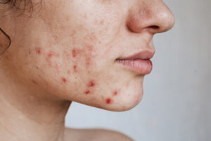 closeup skin young girl with problems pimples acne pores scars natural skin without filters